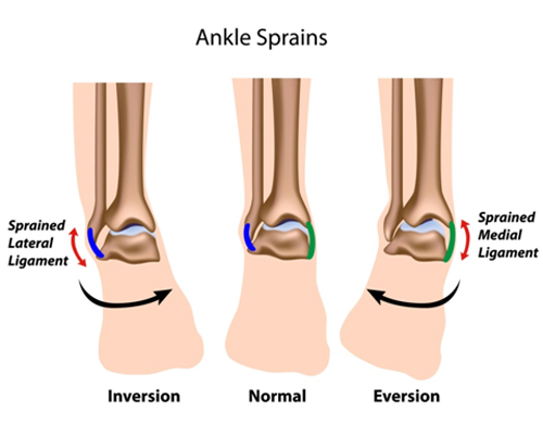 ankle injury, ankle sprain, sprained ankle, twisted ankle, soccer injury ankle