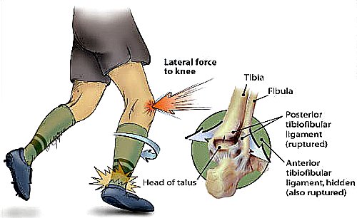 ankle injury, ankle sprain, sprained ankle, twisted ankle, soccer injury ankle